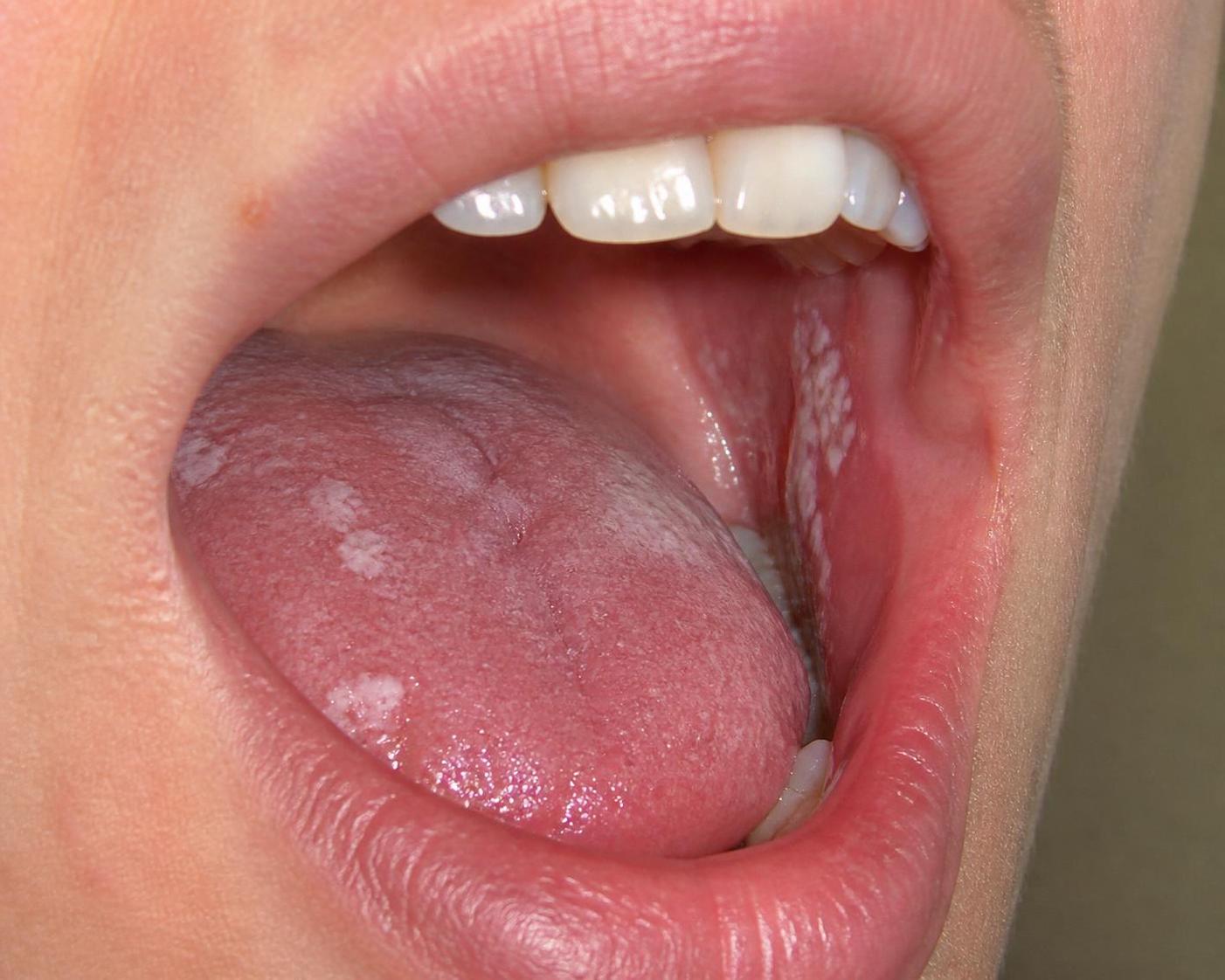 Mycose buccale : symptômes, causes et traitements naturels efficaces 2 découvrez tout sur la mycose buccale : symptômes, causes fréquentes et traitements naturels efficaces pour soulager cette infection. conseils et remèdes pour une bouche saine.