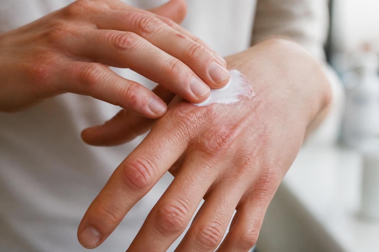 Eczéma sur les mains : causes fréquentes et comment stopper les crises durablement 2 découvrez les causes fréquentes de l'eczéma sur les mains et apprenez des méthodes efficaces pour stopper durablement les crises et soulager votre peau.