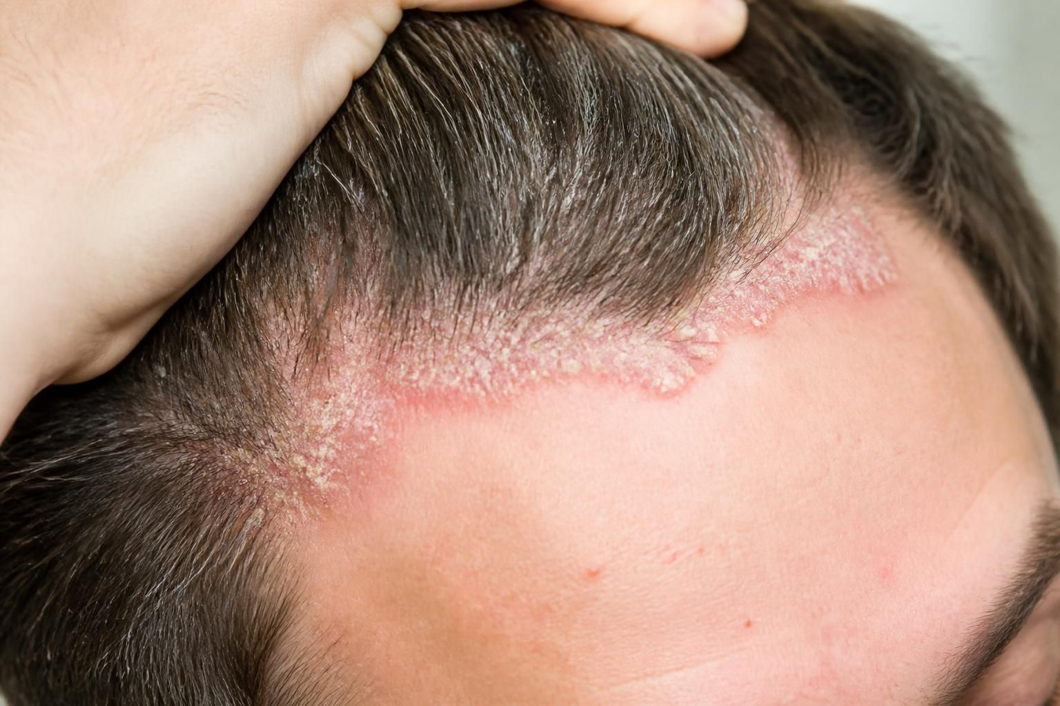 Psoriasis du cuir chevelu : comment le distinguer des pellicules et s'en débarrasser 2 découvrez comment distinguer le psoriasis du cuir chevelu des pellicules et apprenez des méthodes efficaces pour le soulager et s'en débarrasser durablement.